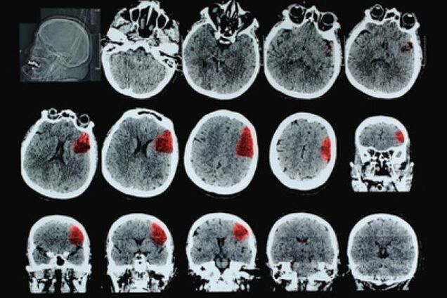 Под ударом: врач рассказала факты об инсульте, которые должен знать каждый