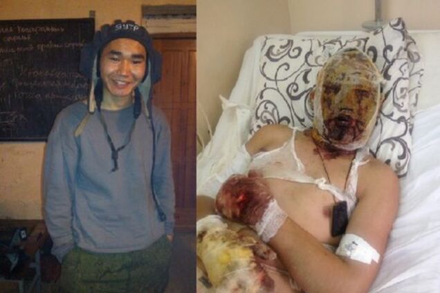 Мать обгоревшего бурята-срочника пожаловалась, что 'герою Новороссии' никто не помогает