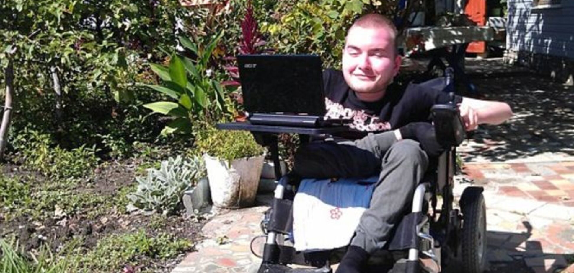 Россиянин может стать первым, кому врачи пересадят голову на новое тело