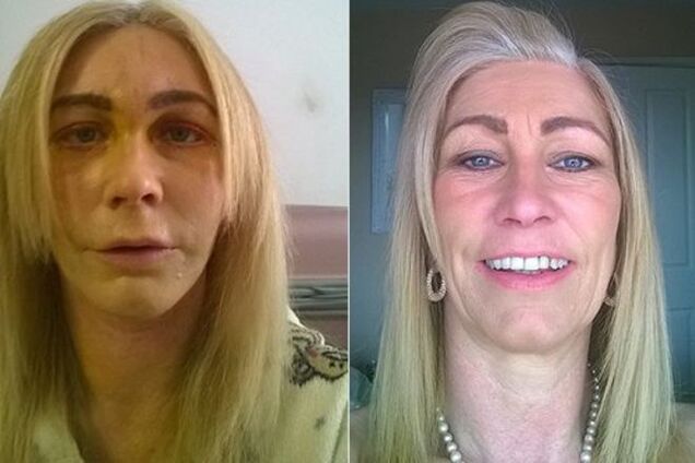 Многодетная британка спустила детские пособия на пластику лица