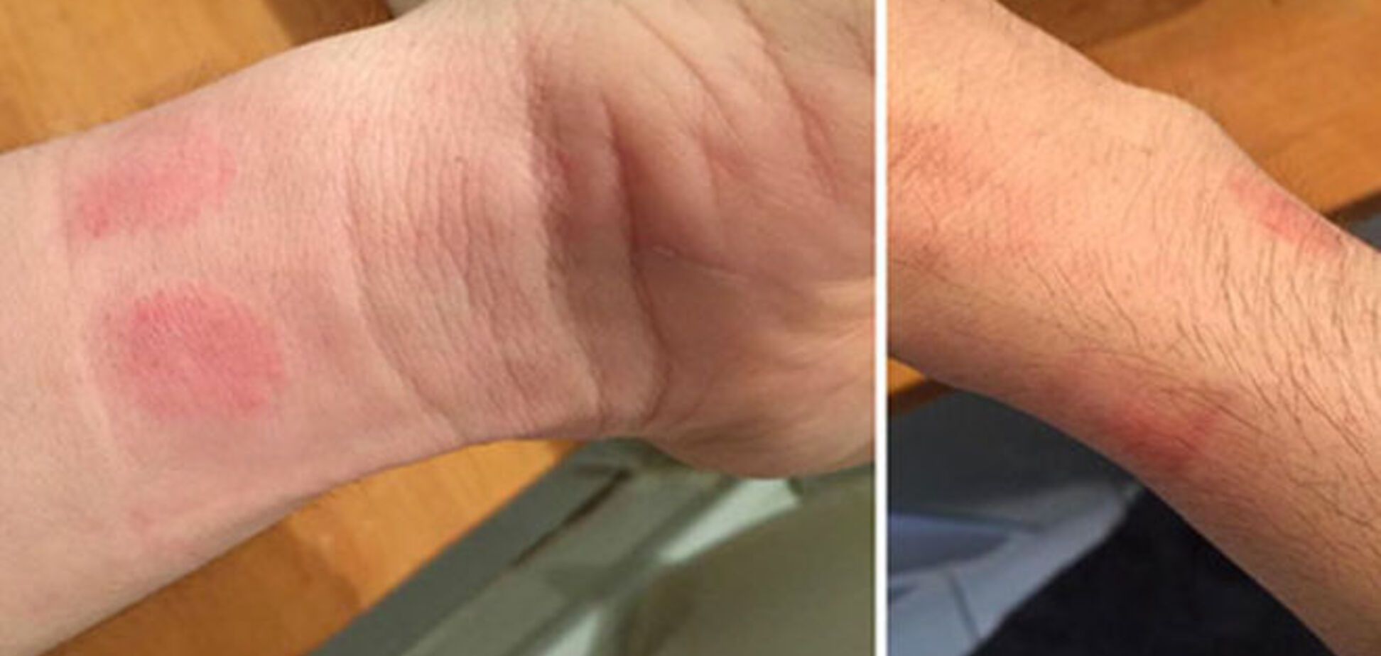 У пользователей Apple Watch начались проблемы с кожей. Фотофакт