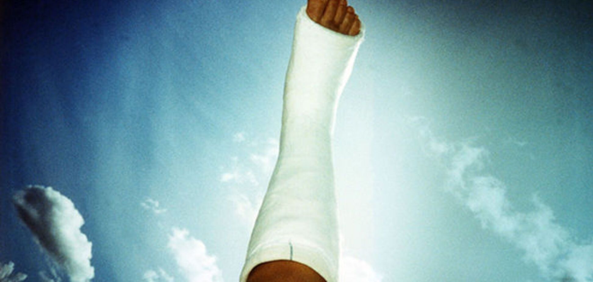 Вот бы нашим раненым такой в АТО! Создан невесомый гипс-паутинка: фотофакт