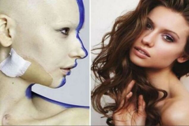 Потрясающие снимки модели, которая потеряла челюсть из-за рака