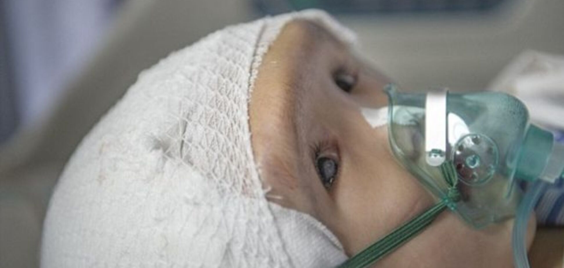 Медики пересадили ребенку череп, напечатанный на 3D-принтере 
