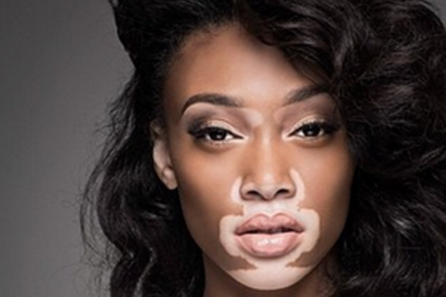 20-летняя модель с необыкновенным кожным заболеванием откровенно рассказала об издевательствах ровесников