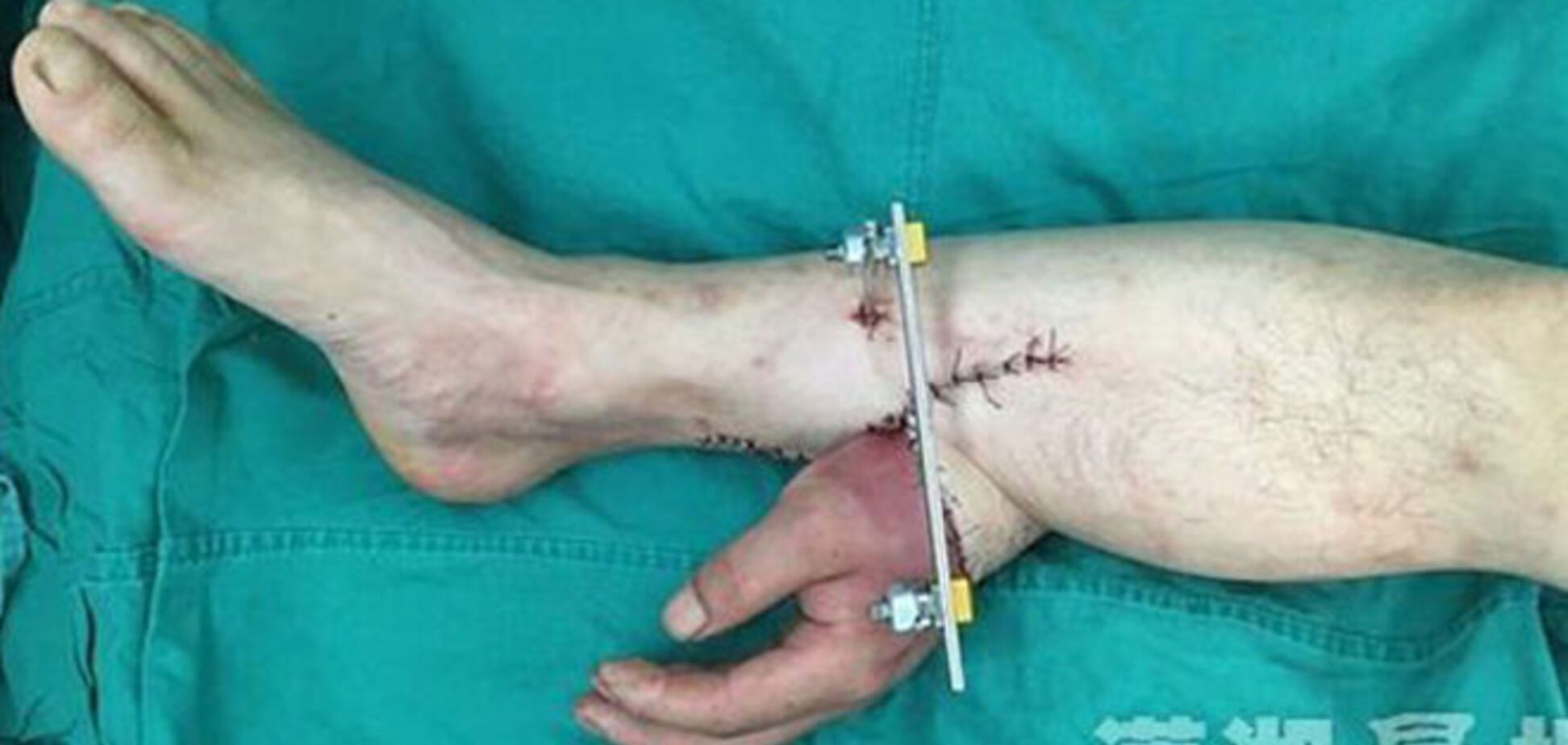 Китайские хирурги пришили руку пациента к его ноге: фотофакт