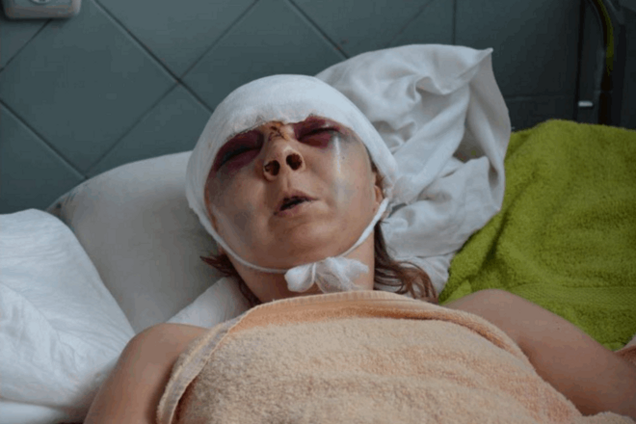 У мережі показали фото звірячому побитої в Києві волонтерки