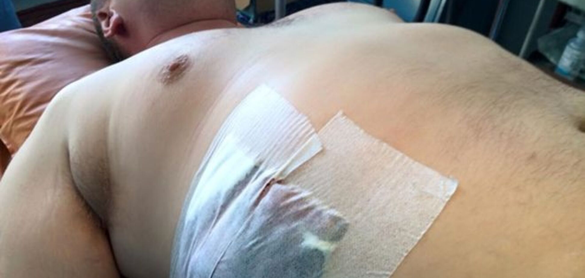 Раненого в АТО Булатова отправили в Киев: экс-министр поделился жуткими фото с операции