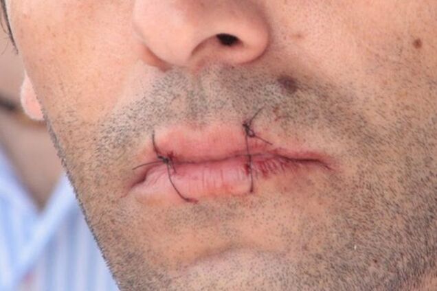 Мне не больно! В Ереване активист 'Тарифного Майдана' зашил себе рот