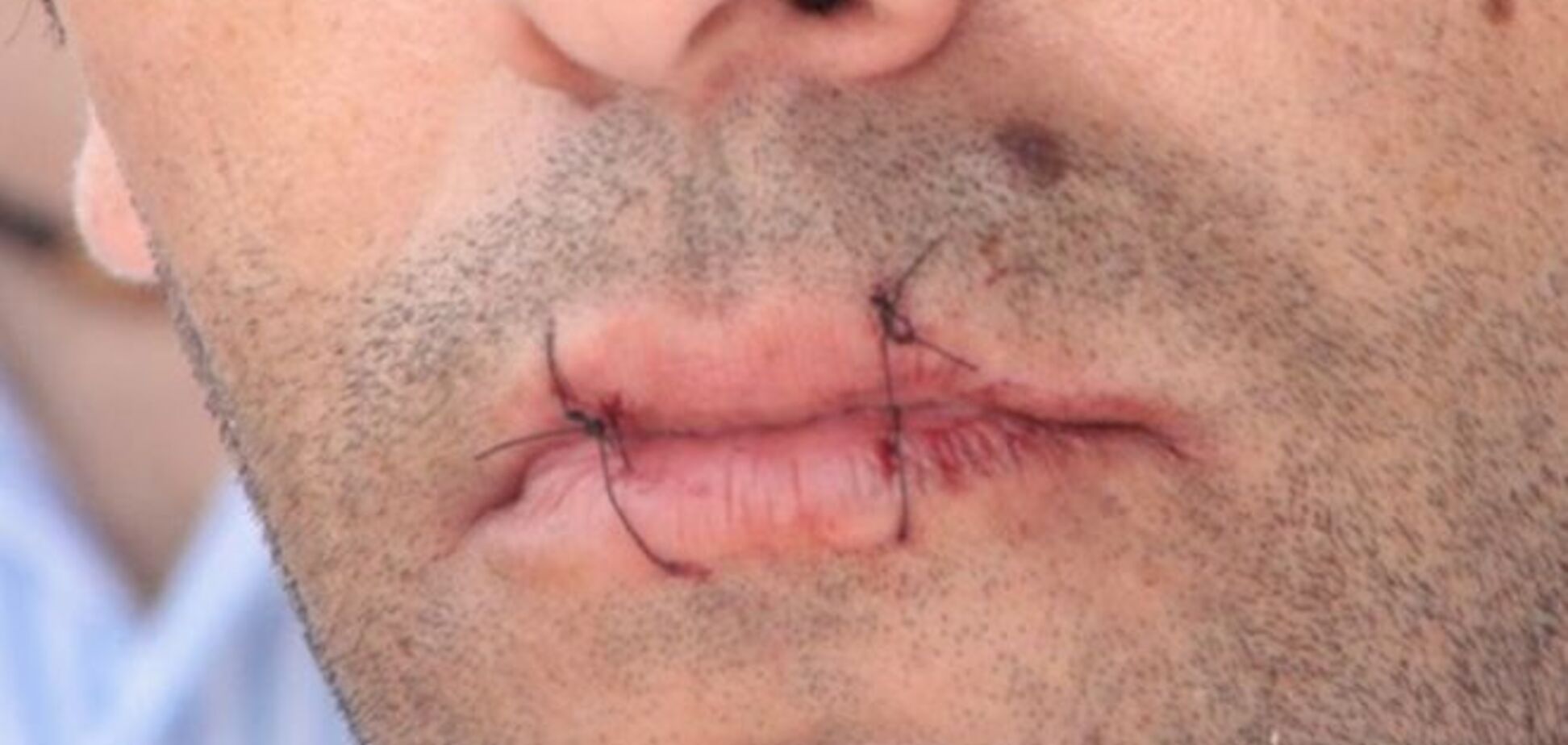 Мне не больно! В Ереване активист 'Тарифного Майдана' зашил себе рот