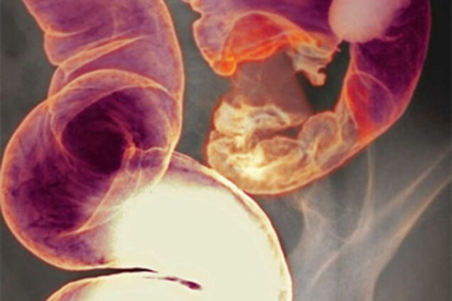 Как распознать рак кишечника: первые симптомы заболевания