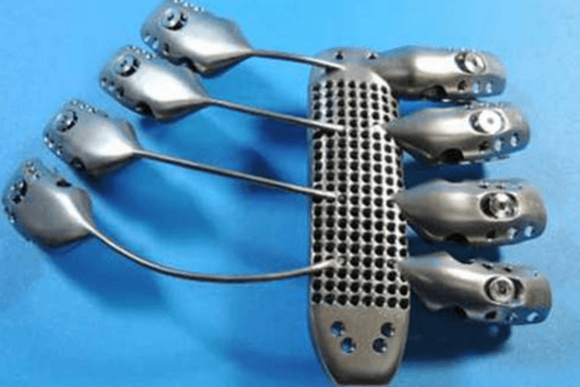 Іспанцеві вставили ребра, надруковані на 3D-принтері: опубліковані фото і відео