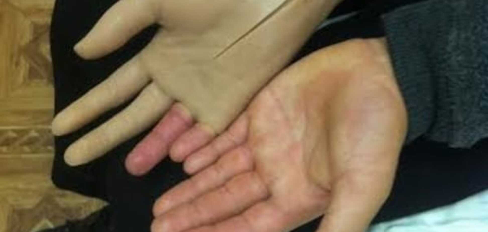 В Киеве впервые протезировали раненого ребенка из Донбасса