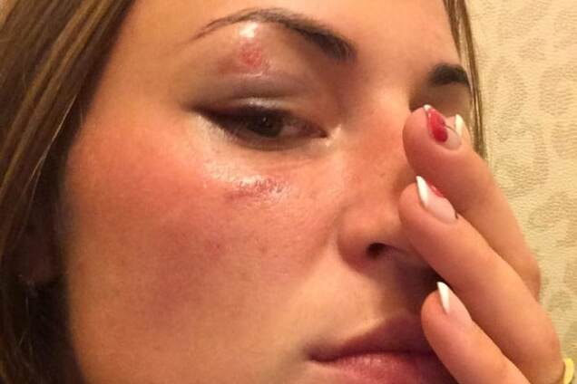 В Киеве жестоко избили телеведущую, пытавшуюся заступиться за девушку: опубликованы фото