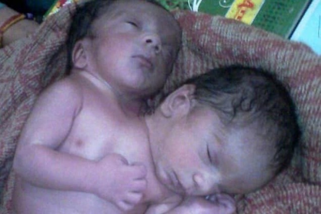 Чудо природы: в Индии родился двухголовый ребенок. Фотофакт
