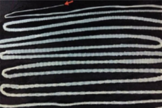 Чужой: в Китае внутри пациента нашли шестиметровое чудовище. Фотофакт