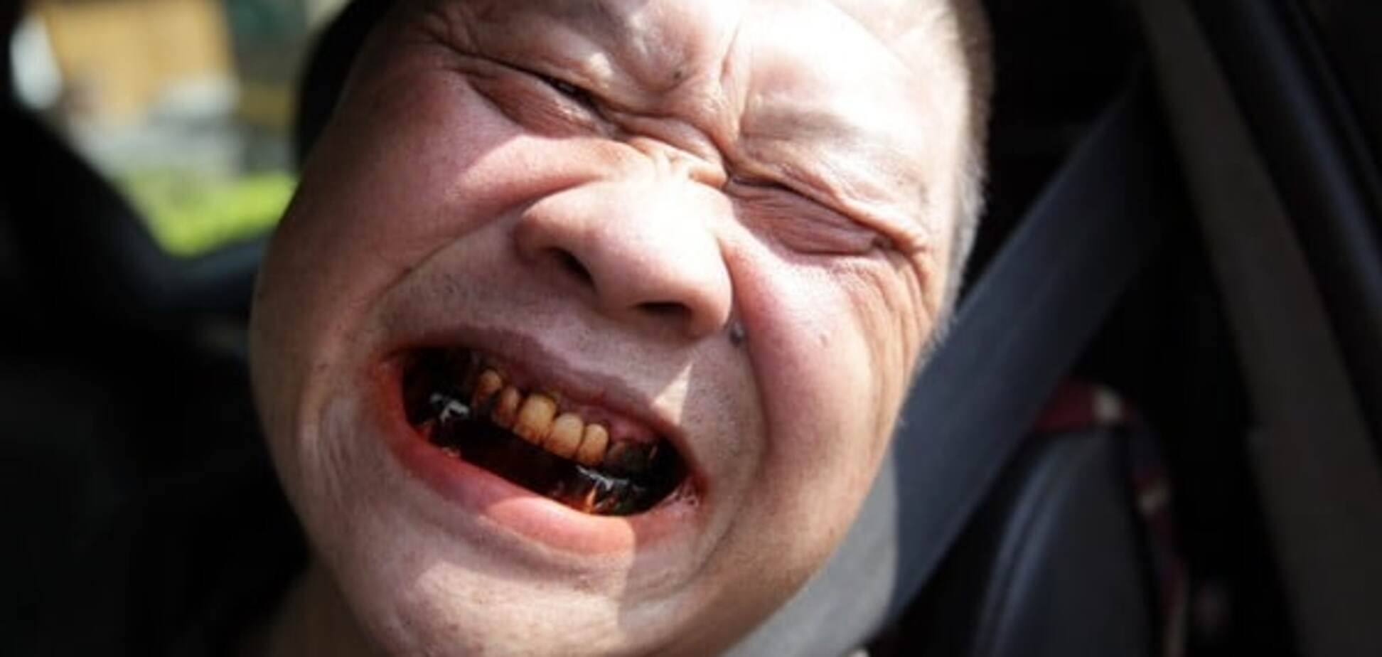 Ученые придумали, как без боли лечить зубы