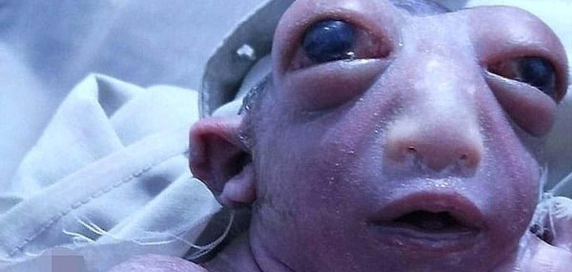 Чудо природы: в Индии родился ребенок без головы