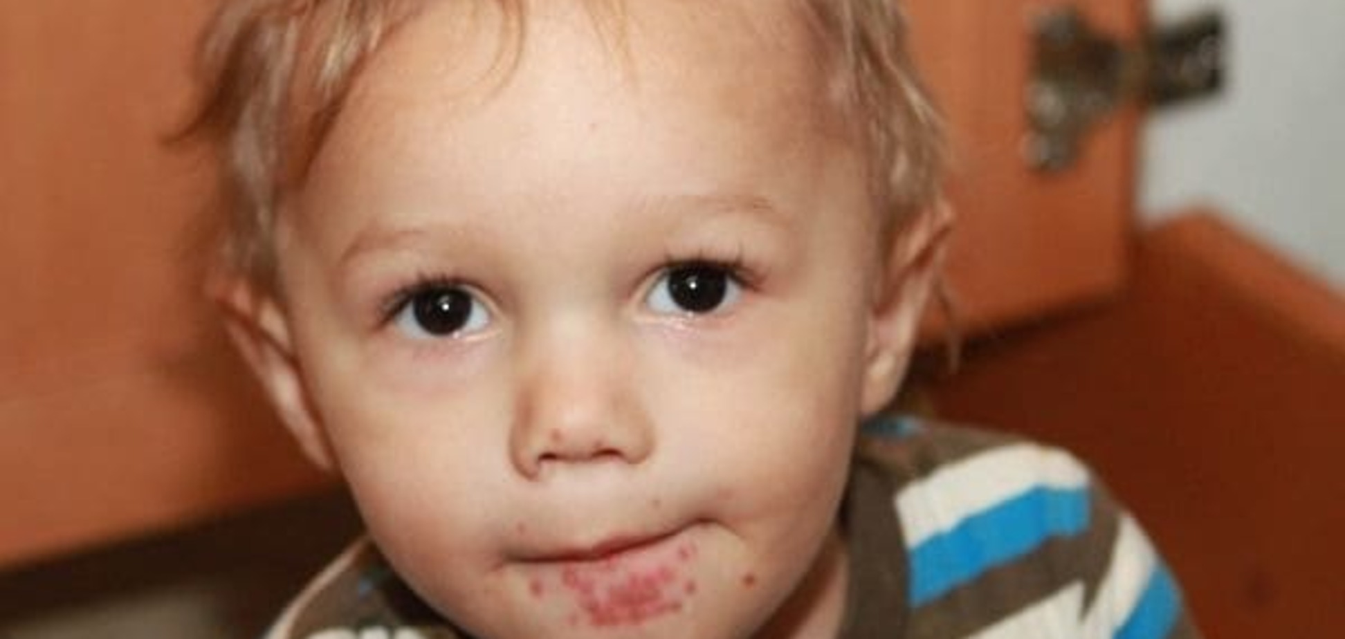 Дитина з ураженням вірусом Коксакі