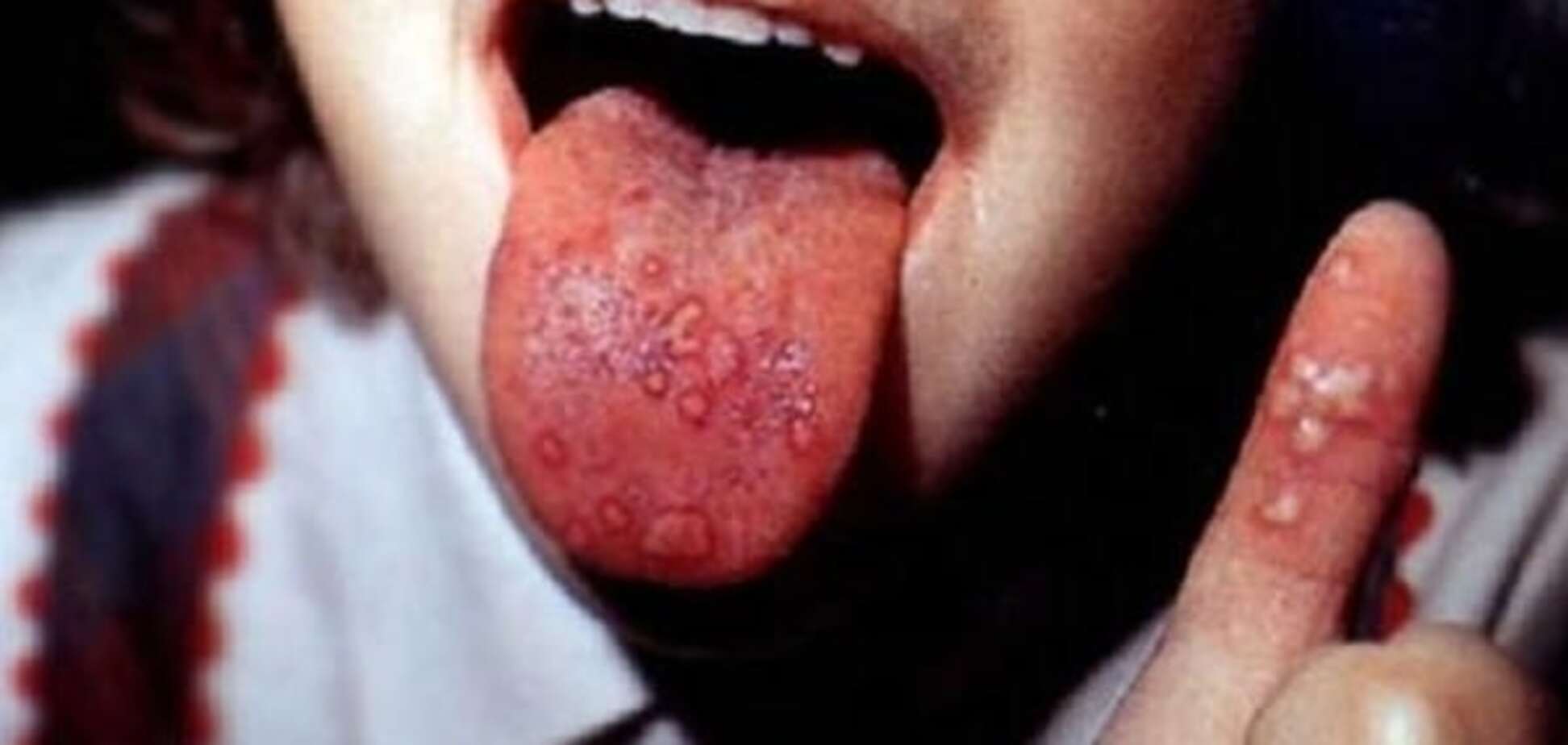 Вірус Коксакі