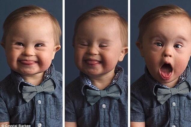 Ребенок с синдромом Дауна