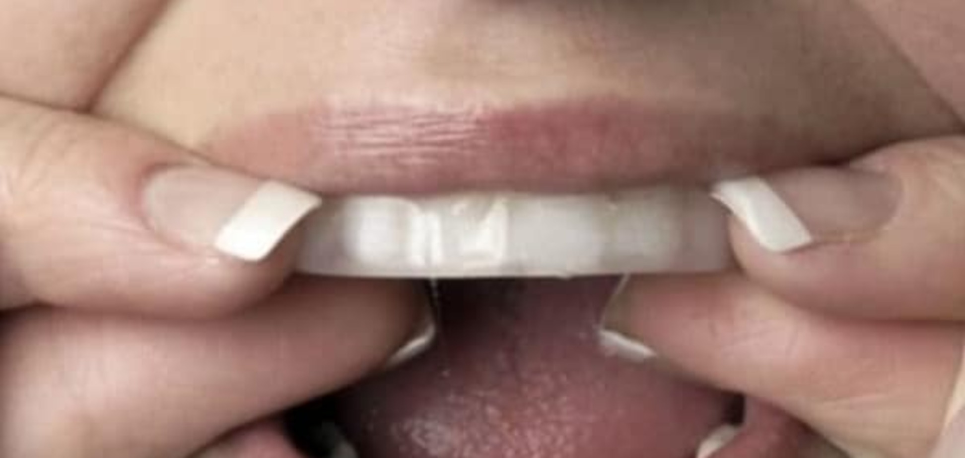 Как отбеливание зубов негативно влияет на здоровье