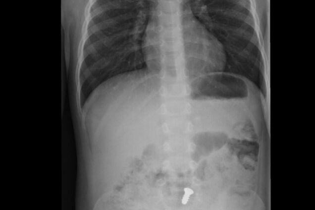 В знак протеста: на Херсонщине заключенный наглотался металла