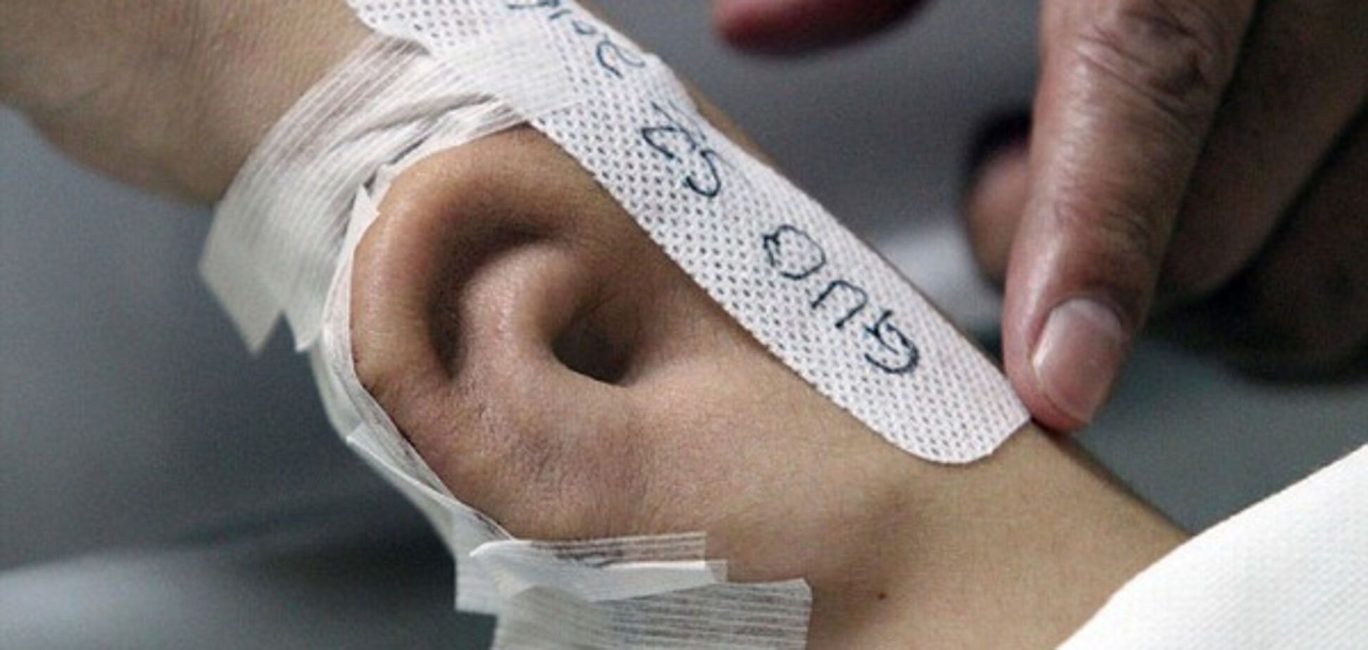 Искусственное ухо, выращенное на руке у пациента