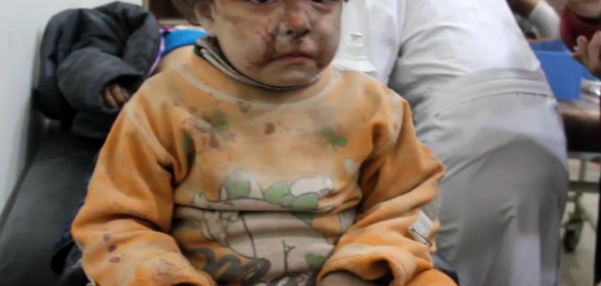 Девочка, пострадавшая во время бомбардировок Алеппо