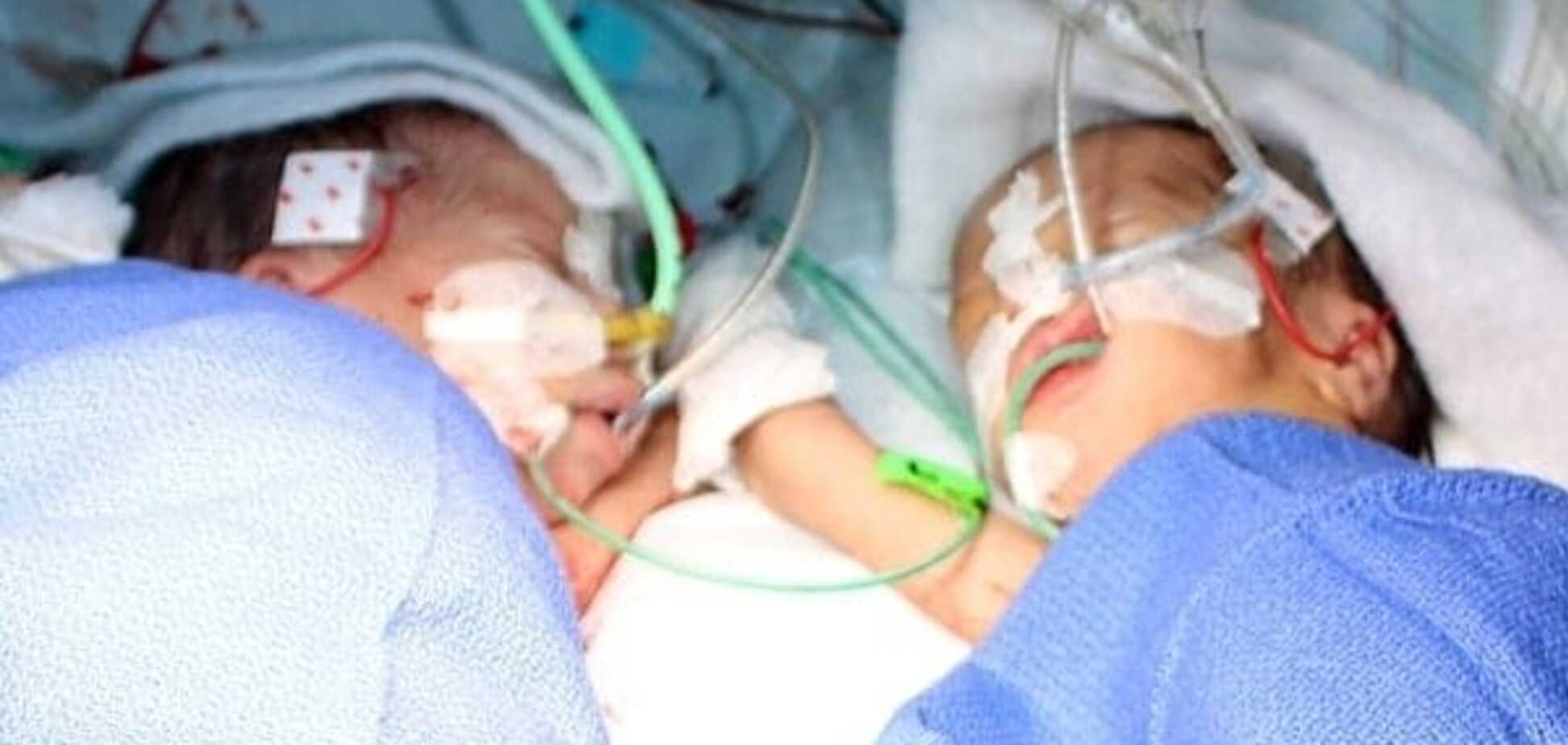 В Швейцарии успешно разделили сиамских близнецов-девочек: фото