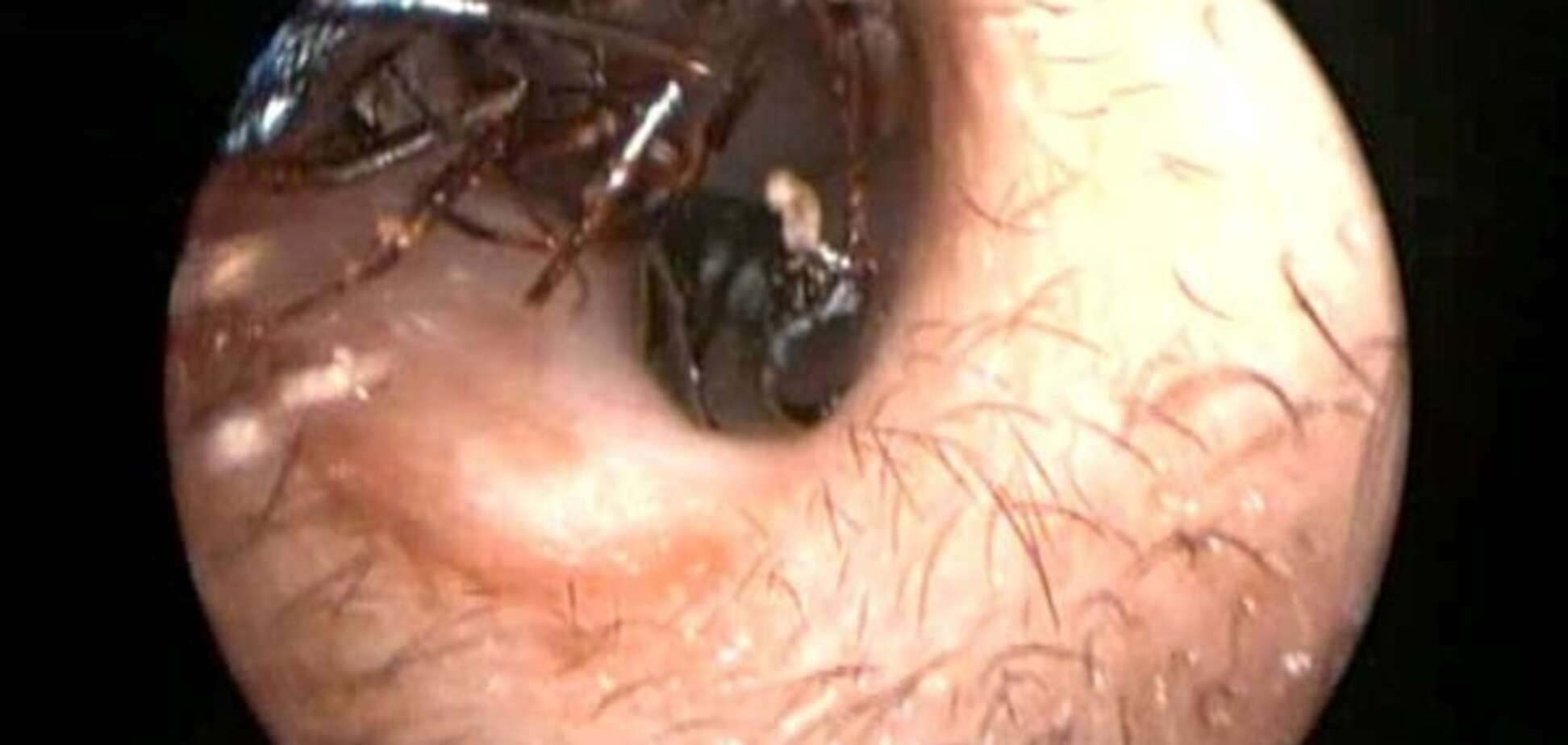 Из уха 12-летней девочки достали гигантских муравьев: опубликовано видео
