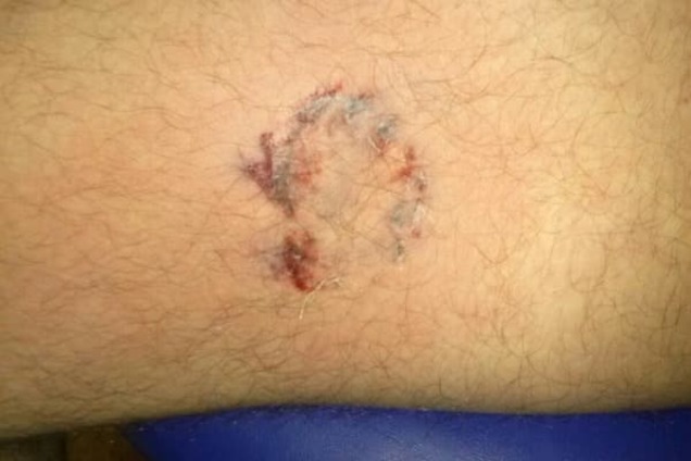 В Киеве иностранец-драчун укусил полицейского