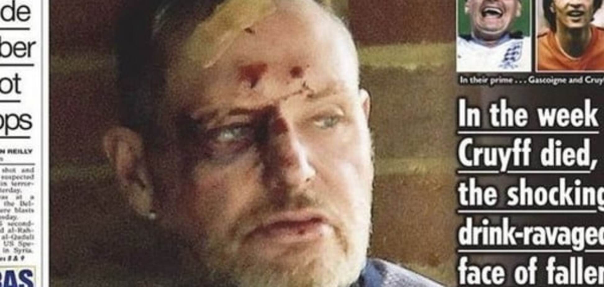 Легендарный футболист сборной Англии найден пьяным с разбитой головой: жуткие фото