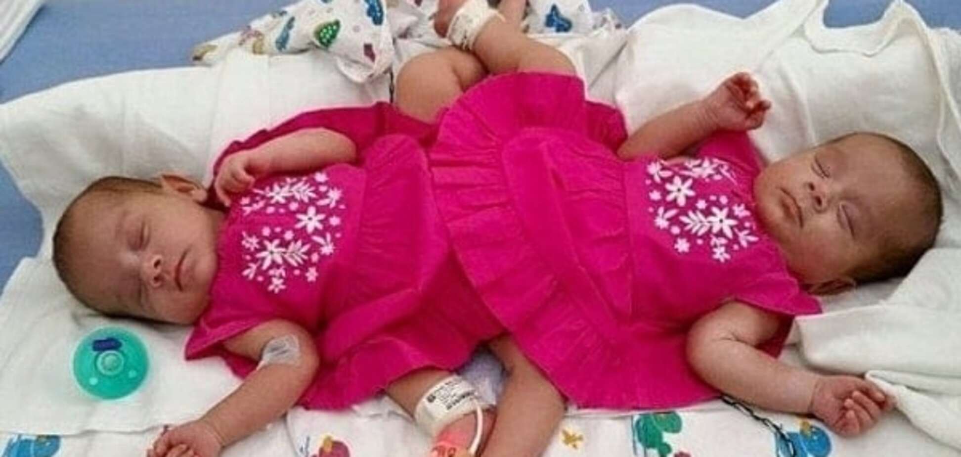 В США разделили сиамских близнецов, сросшихся в области таза  (фото, видео)