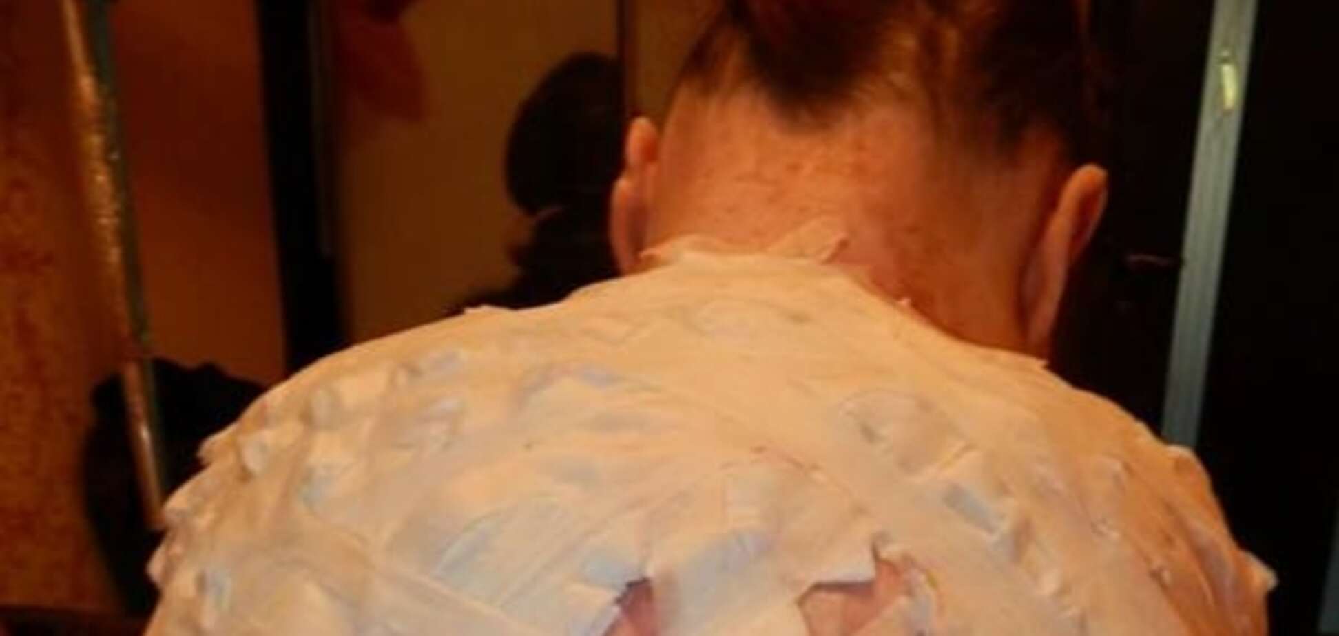 Жизнь без кожи: украинцев просят спасти девушку-бабочку 