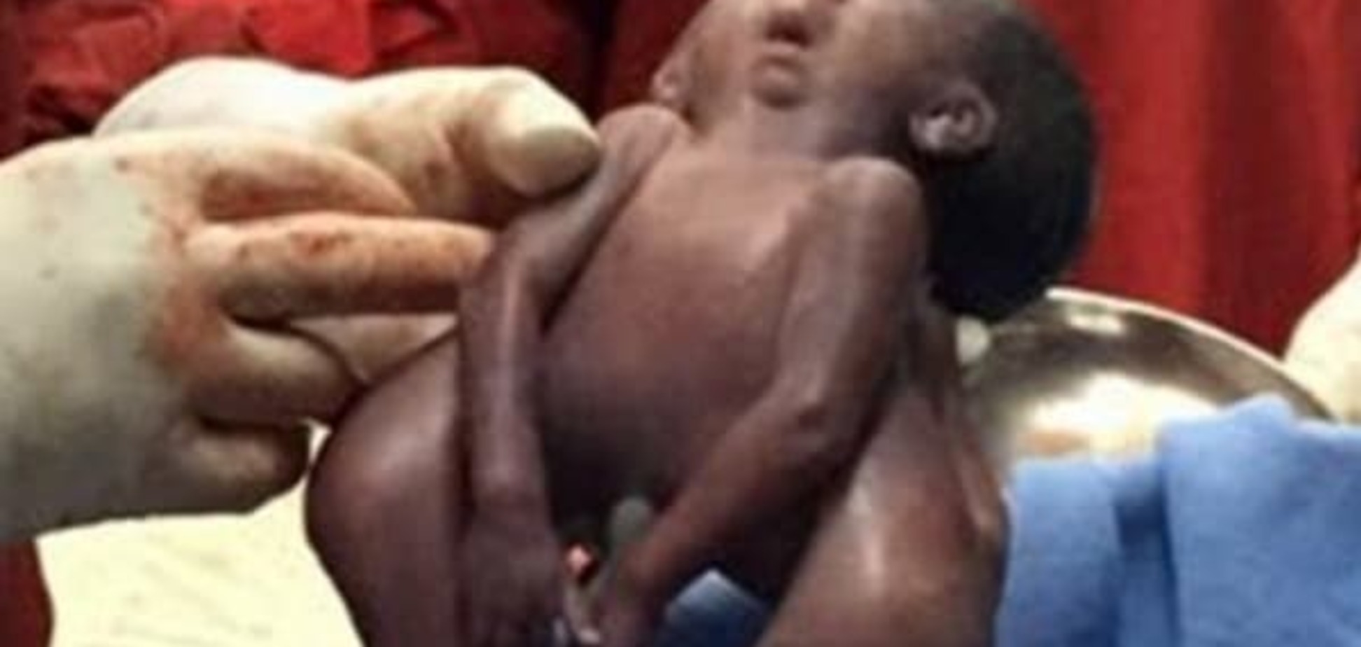 Сиамские близнецы