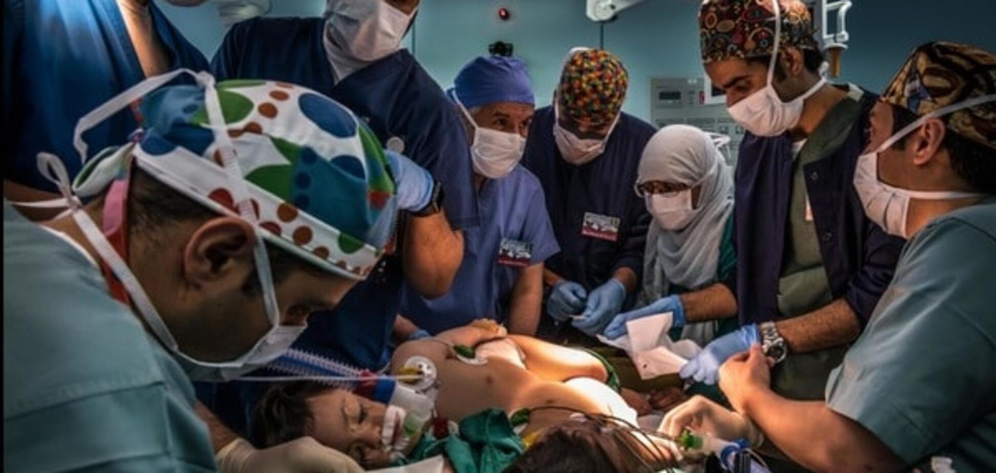 Сиамские близнецы