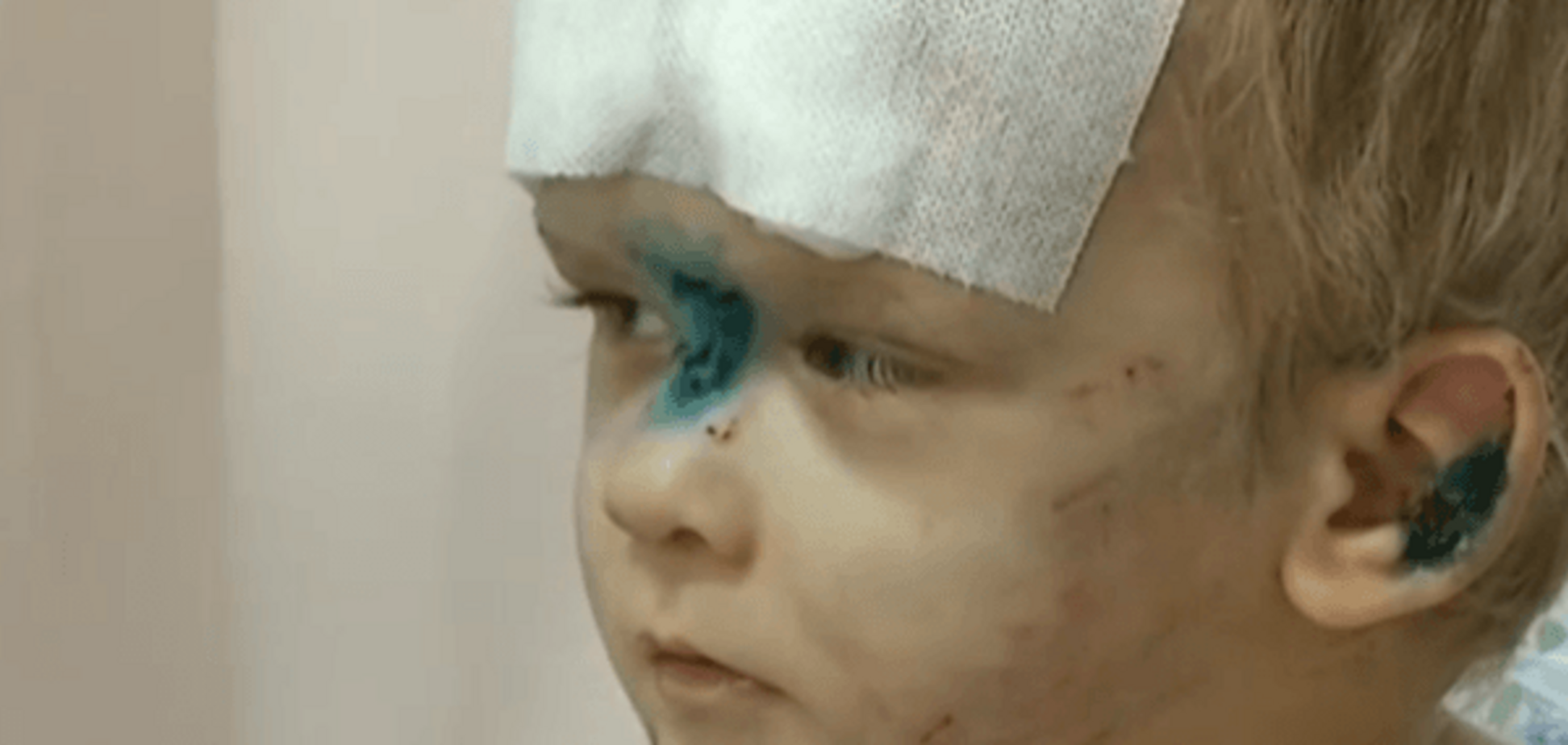 Избитый ребенок