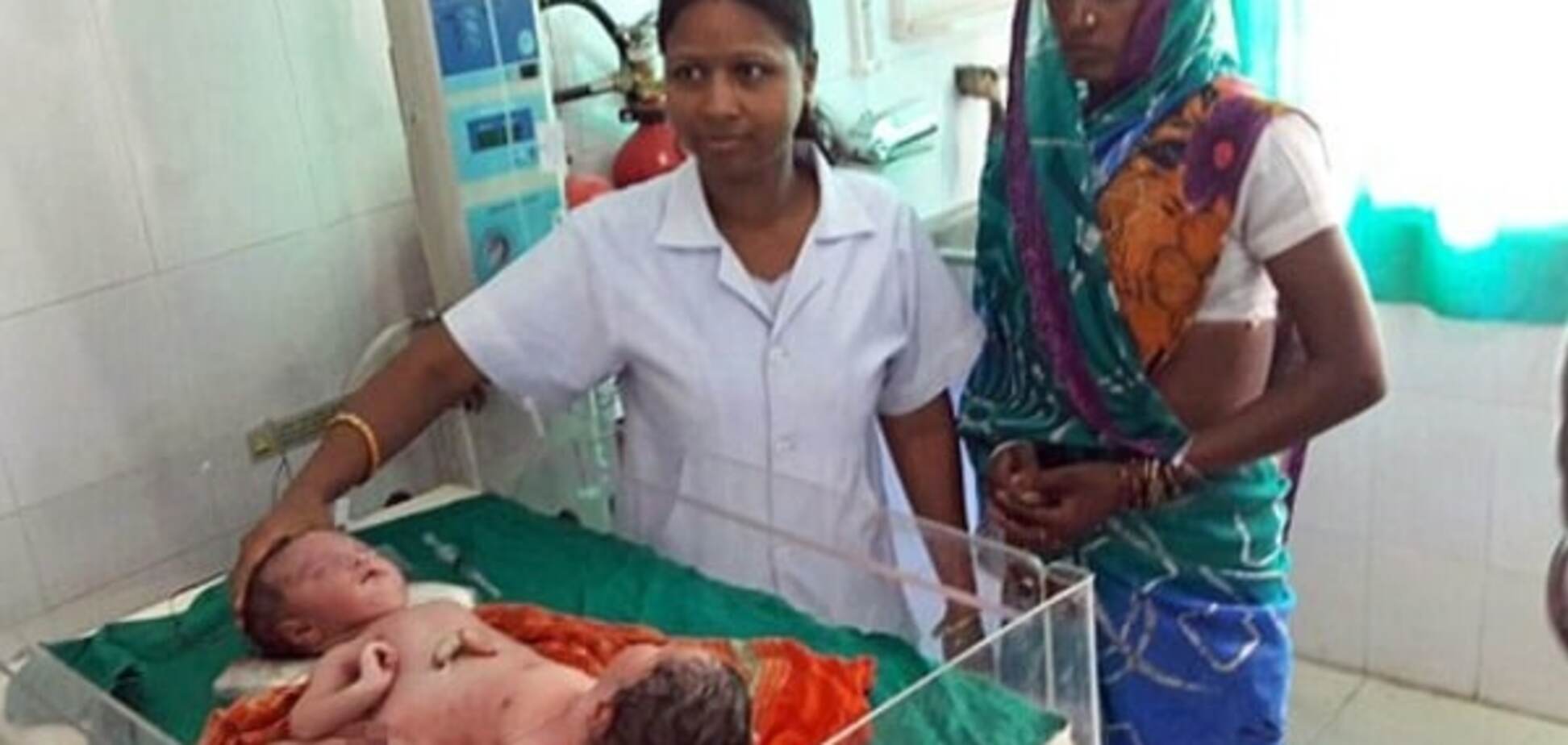 Сиамские близнецы