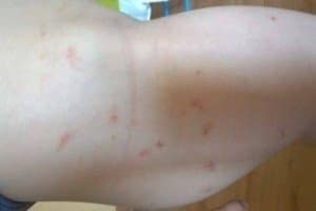 На Закарпатті у дитячому садку малюка покусали клопи