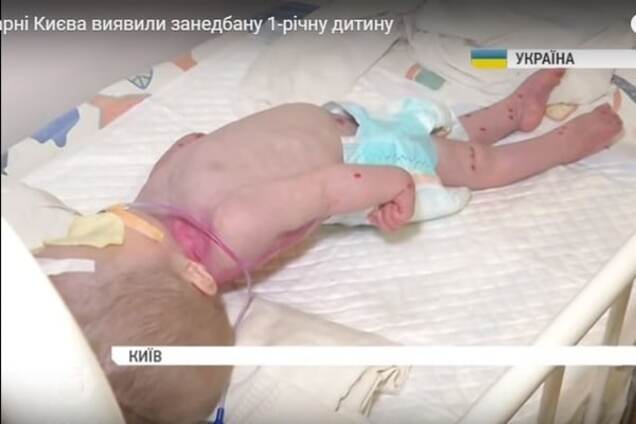 У лікарні Києва знайшли дитину в жахливому стані