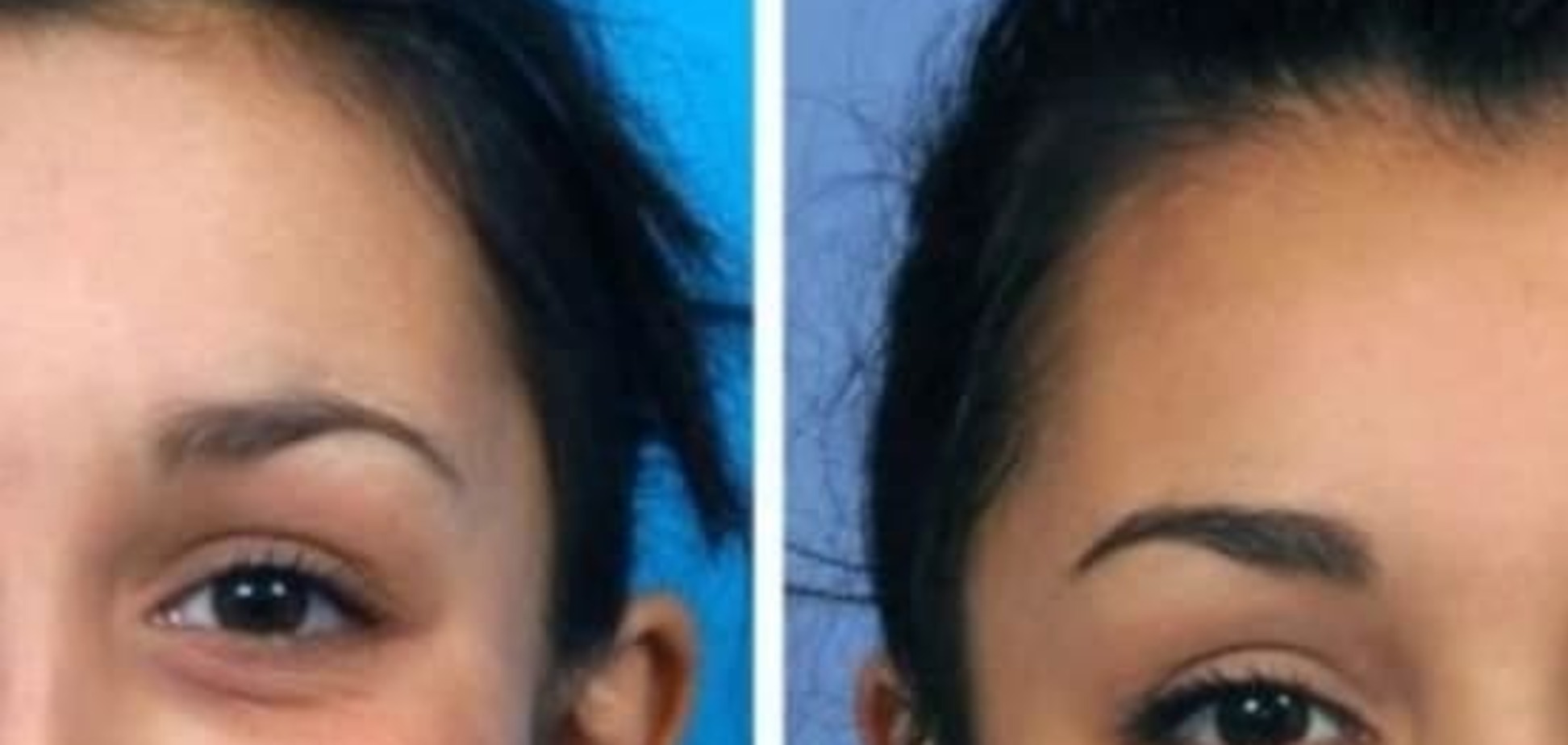 Чудеса пластической хирургии: медики помогли девушке с деформированной челюстью стать красавицей