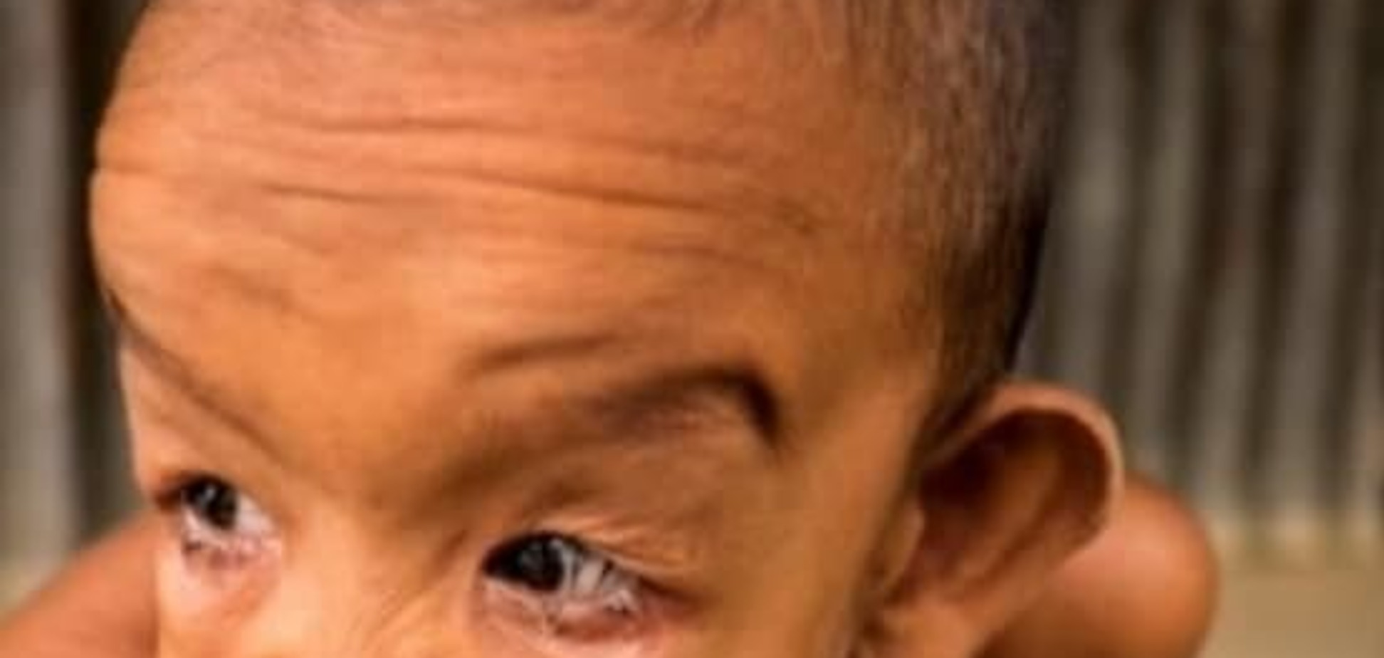 Родился 80-летним: в Индии обнаружили уникального ребенка