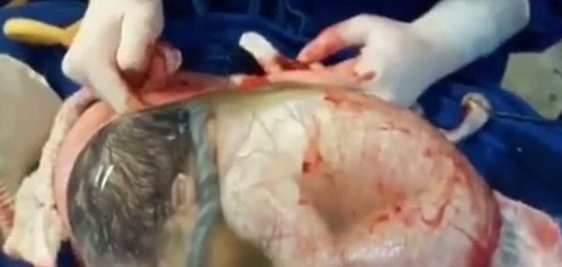 Ребенок в амниотическом пузыре