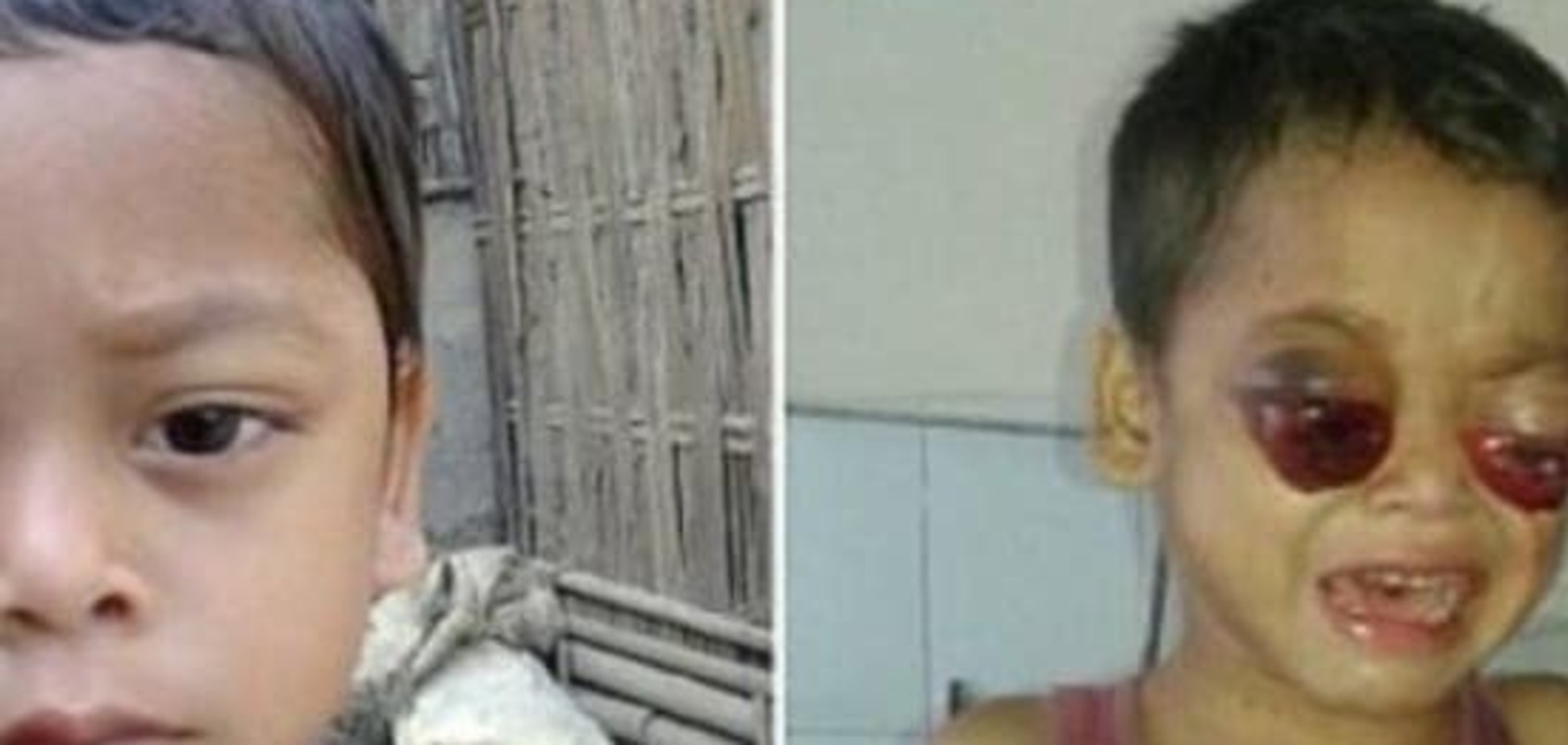 У индийского мальчика из-за неустановленной болезни вытекают глаза. Опубликовано фото