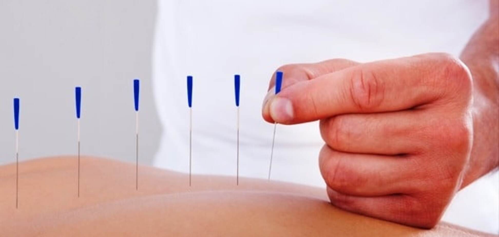 Иглоукалывание