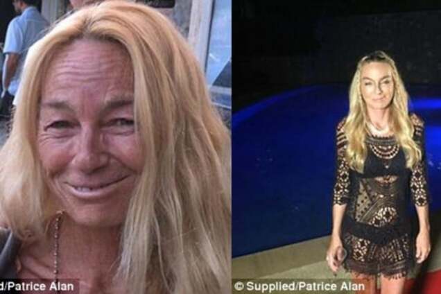 'Дочь Франкенштейна' из Австралии невероятно преобразилась после операции в Таиланде: опубликованы фото