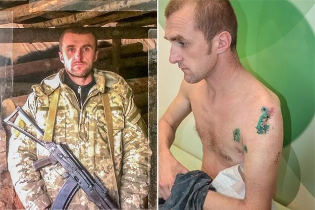 Волонтери оголосили збір коштів на лікування руки бійця АТО унікальними біотехнологіями