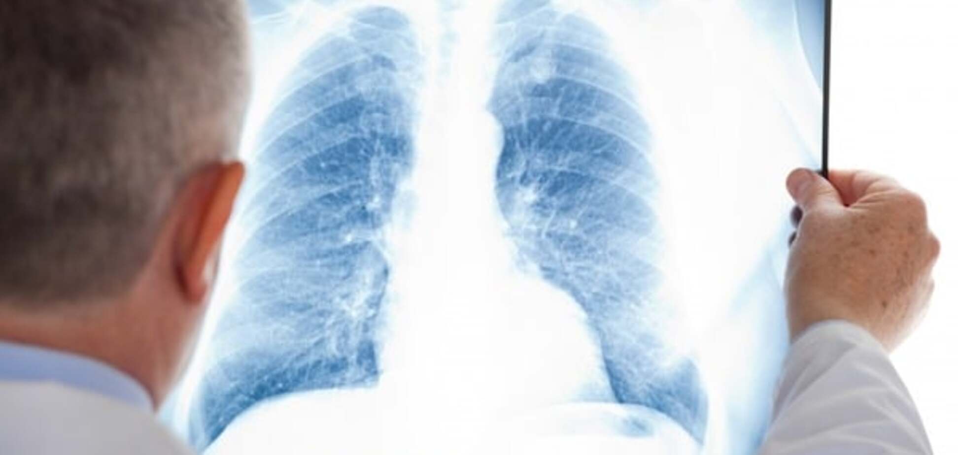 В Крыму резко выросла заболеваемость туберкулезом среди детей