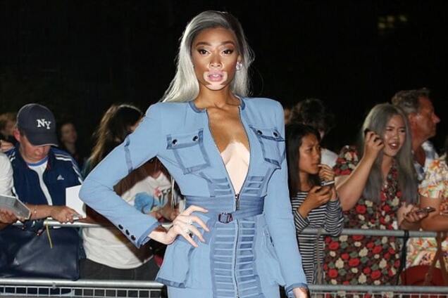 Модель с неизлечимой болезнью кожи показала стройные ноги в миниплатье